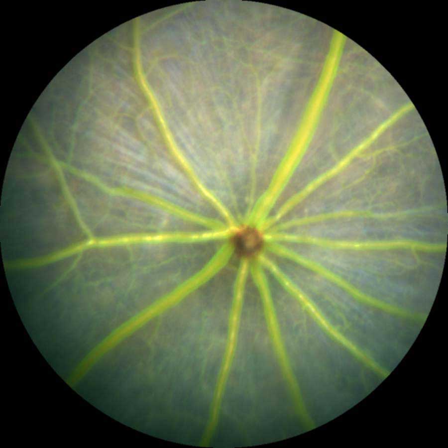 Fluorescein Angiography Image